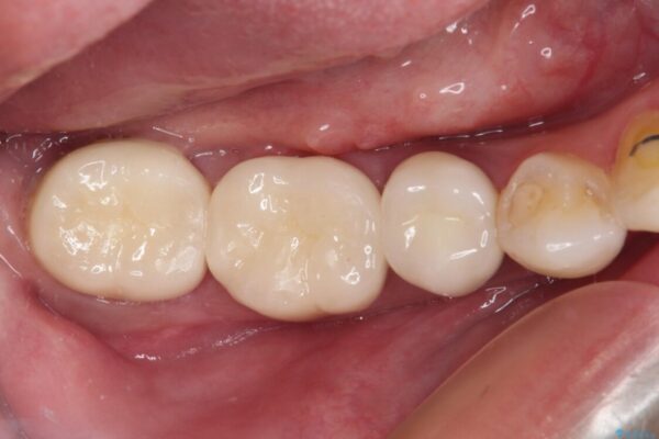 奥歯がしみる　色々な国で治療を受けてきた奥歯のむし歯治療 治療後画像