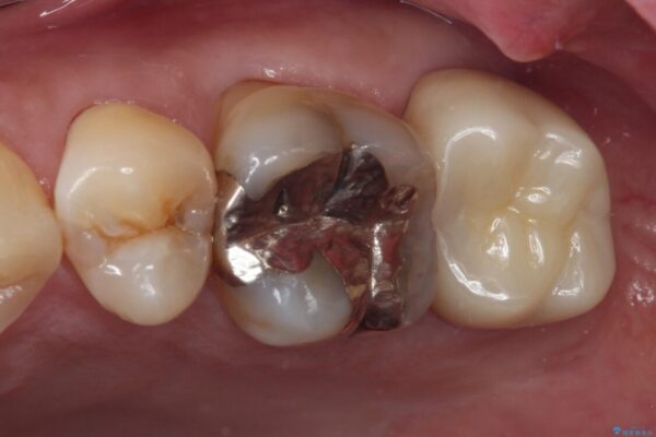 歯に穴が空いてしみる　ものが挟まってしまうほど大きな奥歯のむし歯 治療後画像