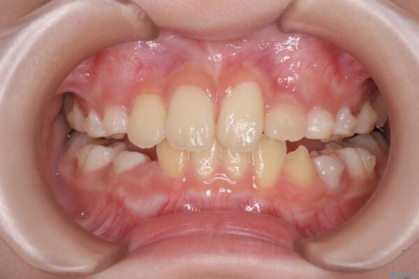 過剰歯を抜歯して前歯を排列　インビザライン・ファーストによる小学生のⅠ期治療 治療途中画像