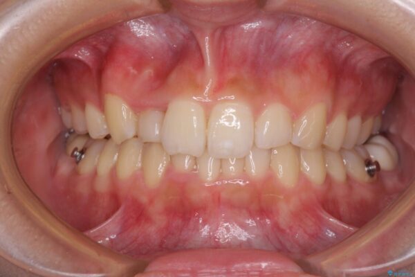 気になる八重歯を改善　補助装置併用のインビザライン治療 治療途中画像
