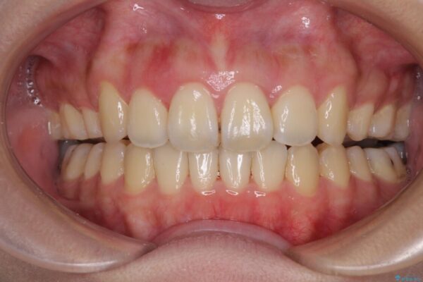 補助装置を使ったインビザラインによる抜歯矯正 治療途中画像