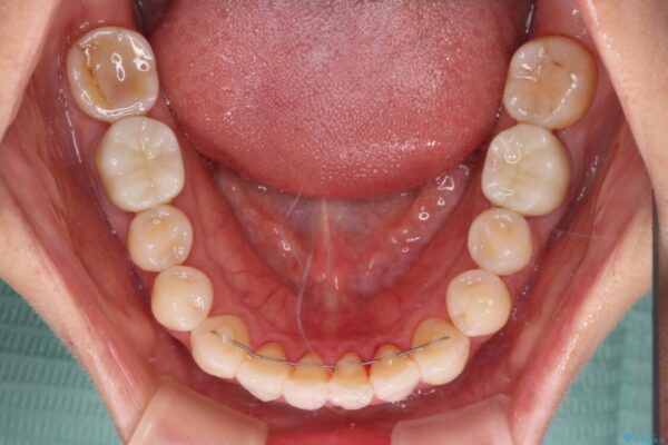 気になる前歯をインビザライン・ライトで　矯正治療後には銀歯をセラミックに 治療後画像
