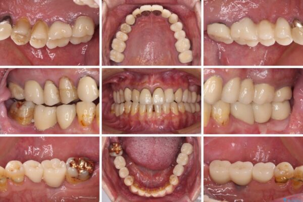 下顎の部分矯正を行ってから奥歯の補綴治療とインプラント治療 治療後画像
