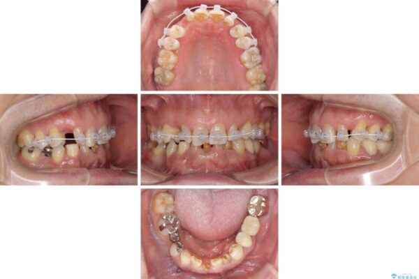 乳歯や矮小歯の多い前歯　部分矯正と補綴治療による審美歯科治療 治療途中画像