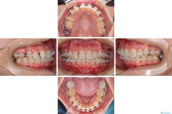 上顎の八重歯と下顎前歯の欠損　ワイヤー装置による抜歯矯正 治療途中画像