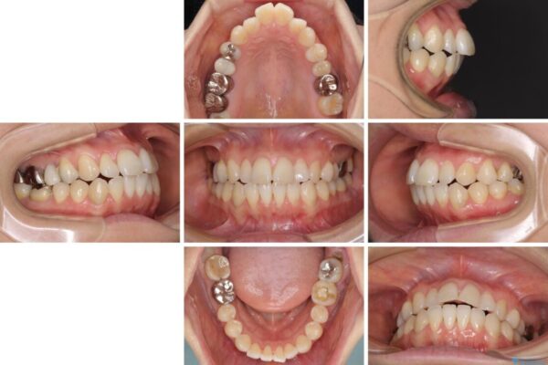 気になる前歯をインビザライン・ライトで　矯正治療後には銀歯をセラミックに 治療前画像
