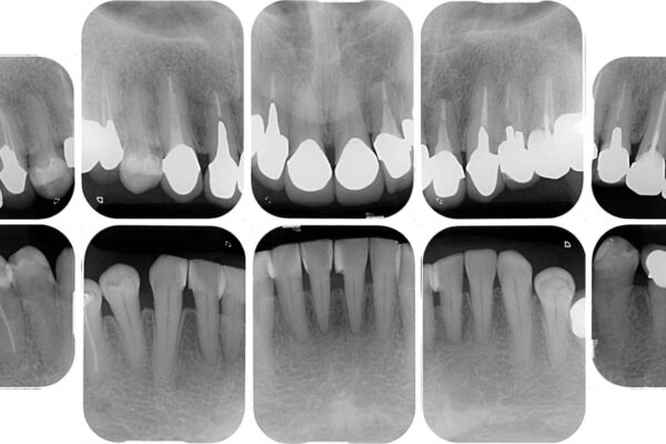 下顎の部分矯正を行ってから奥歯の補綴治療とインプラント治療 治療前画像