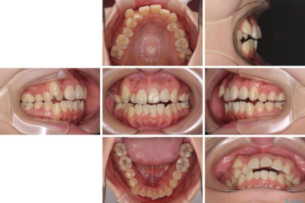 補助装置を使ったインビザラインによる抜歯矯正 治療前画像