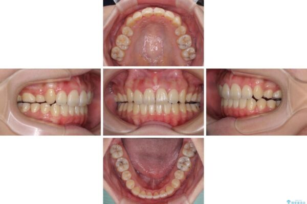 補助装置を使ったインビザラインによる抜歯矯正 治療途中画像