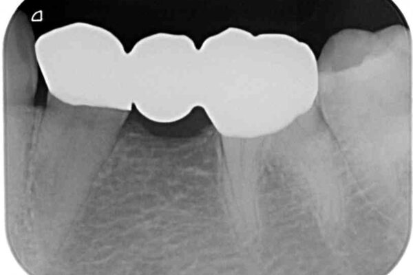 割れてしまった奥歯をインプラントで　気になる銀歯もセラミッククラウンで審美的に 治療後画像
