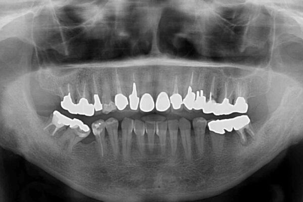 下顎の部分矯正を行ってから奥歯の補綴治療とインプラント治療 治療前画像
