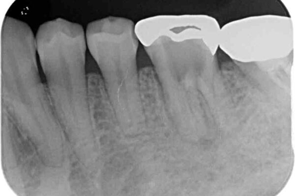 痛む奥歯と矯正の後戻り　インビザライン・ライトとセラミック治療 治療前画像