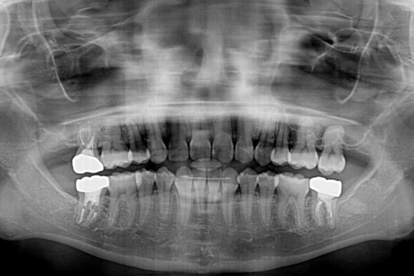 上顎の八重歯と下顎前歯の欠損　ワイヤー装置による抜歯矯正 治療後画像