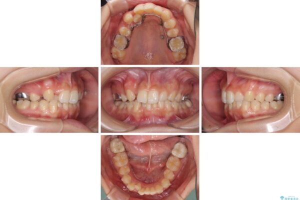 気になる八重歯を改善　補助装置併用のインビザライン治療 治療途中画像
