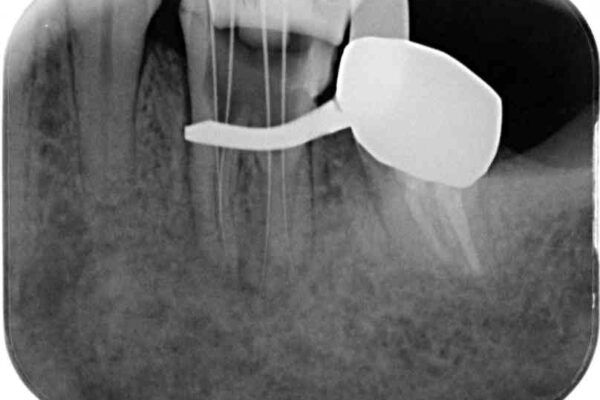 痛む奥歯と矯正の後戻り　インビザライン・ライトとセラミック治療 治療途中画像