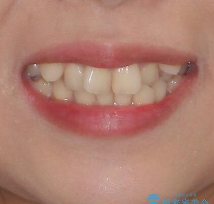 上顎の八重歯と下顎前歯の欠損　ワイヤー装置による抜歯矯正 治療前画像