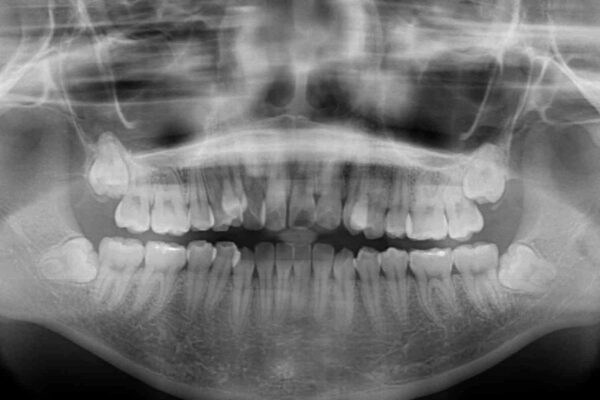 補助装置を使ったインビザラインによる抜歯矯正 治療前画像