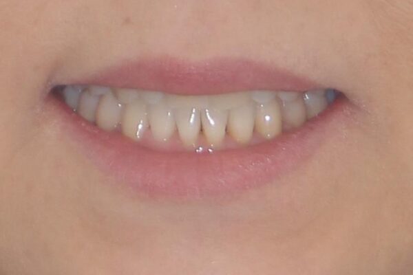 前歯のスペースが気になる　インビザラインによる矯正治療 治療後画像