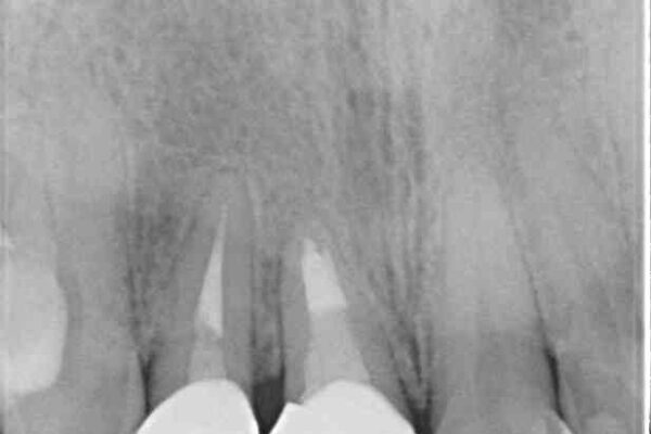 前歯のクロスバイトと治療が必要なむし歯　矯正とセラミックの総合歯科治療 治療後画像