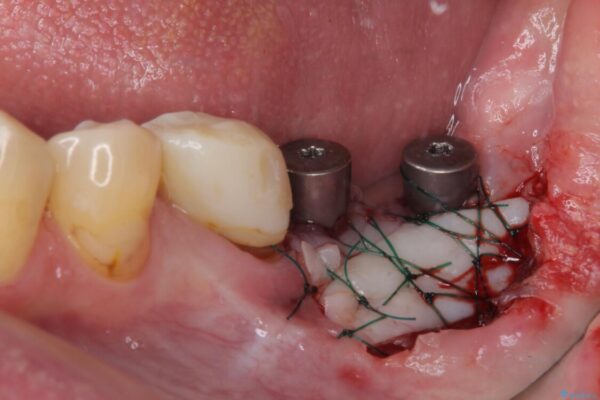 下顎の部分矯正を行ってから奥歯の補綴治療とインプラント治療 治療途中画像