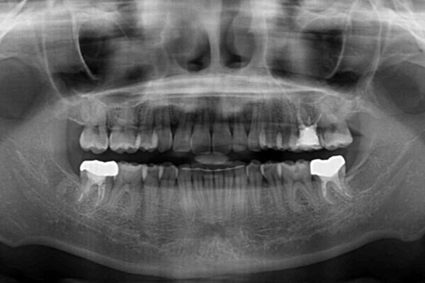 気になる八重歯を改善　補助装置併用のインビザライン治療 治療後画像