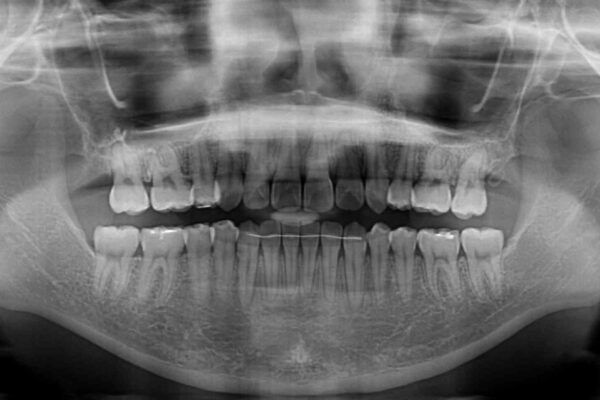 補助装置を使ったインビザラインによる抜歯矯正 治療後画像
