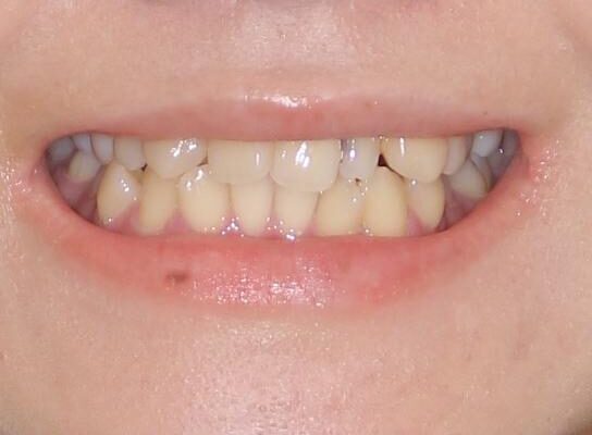 八重歯の抜歯矯正　補助装置を用いたインビザライン矯正 治療前画像