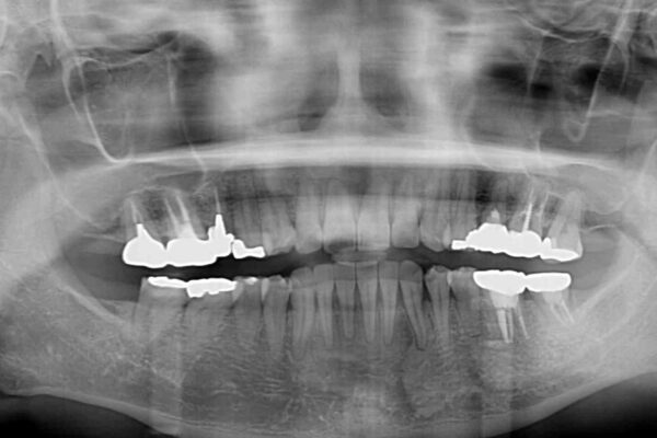 痛む奥歯と矯正の後戻り　インビザライン・ライトとセラミック治療 治療後画像