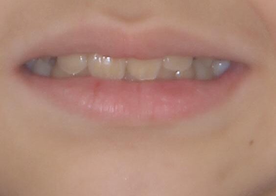 過剰歯を抜歯して前歯を排列　インビザライン・ファーストによる小学生のⅠ期治療 治療後画像