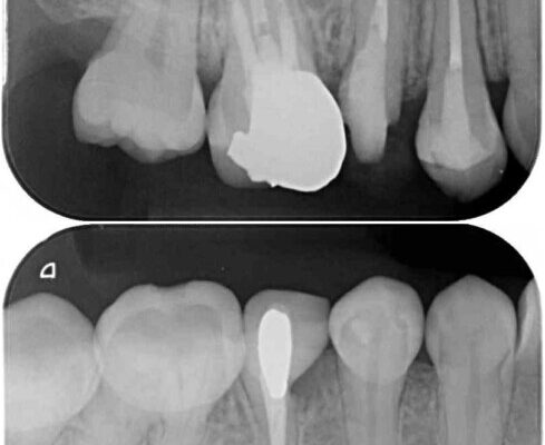 前歯のクロスバイトと治療が必要なむし歯　矯正とセラミックの総合歯科治療 治療前画像
