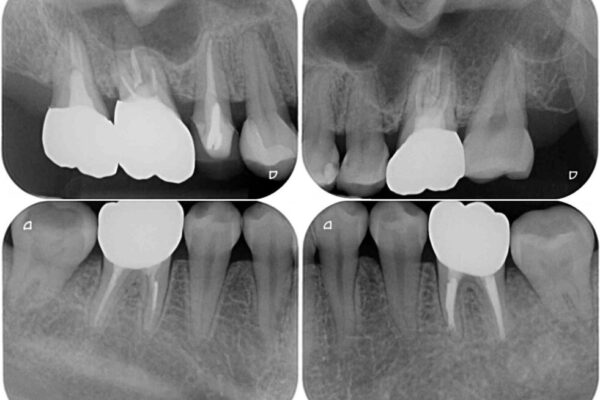 気になる前歯をインビザライン・ライトで　矯正治療後には銀歯をセラミックに 治療後画像