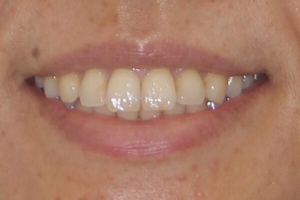痛む奥歯と矯正の後戻り　インビザライン・ライトとセラミック治療 治療前画像