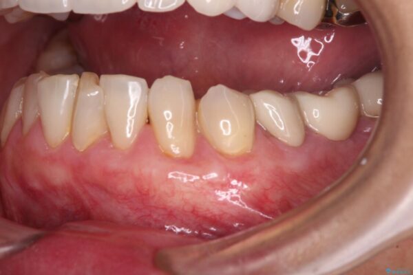 歯磨きの度にしみる歯　露出した歯根を歯肉移植で改善 アフター