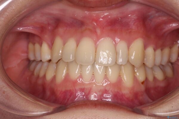 八重歯の抜歯矯正　補助装置を用いたインビザライン矯正 治療後画像