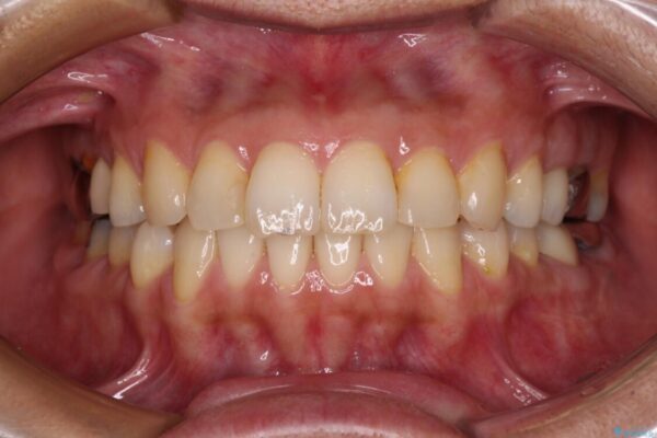 痛む奥歯と矯正の後戻り　インビザライン・ライトとセラミック治療 治療後画像
