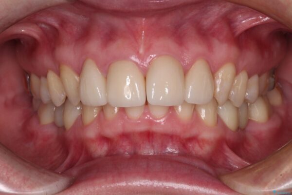 割れてしまった奥歯をインプラントで　気になる銀歯もセラミッククラウンで審美的に 治療後画像