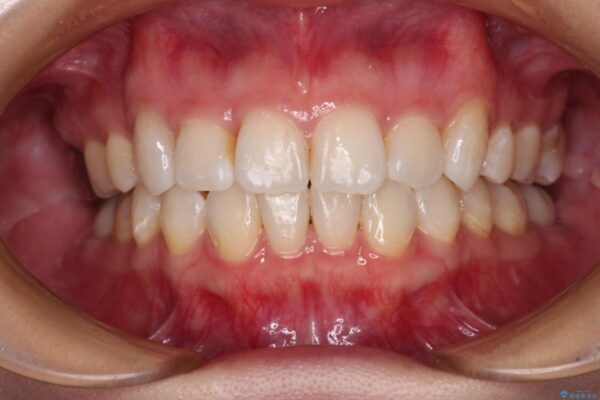 上顎の八重歯と下顎前歯の欠損　ワイヤー装置による抜歯矯正 アフター