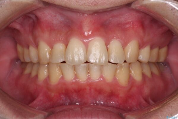 強い咬み込みですり減った前歯　デコボコを抜歯矯正で整える アフター