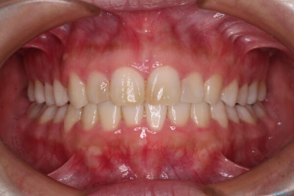 気になる前歯を治したい　インビザラインで気づかれずに矯正治療 治療後画像