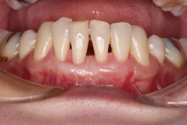 下顎前歯の歯肉退縮　歯肉移植による根面被覆 治療後画像
