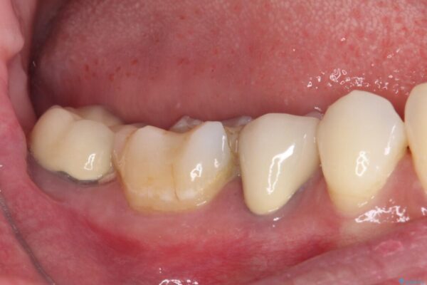 奥歯がしみる　色々な国で治療を受けてきた奥歯のむし歯治療 治療前画像