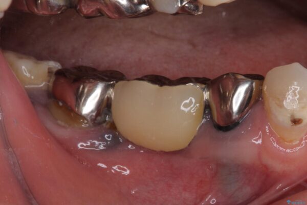 痛む奥歯　目立つ銀色の奥歯をセラミックに　セラミックブリッジ 治療前画像