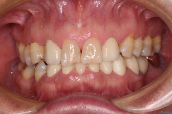 乳歯や矮小歯の多い前歯　部分矯正と補綴治療による審美歯科治療 治療後画像