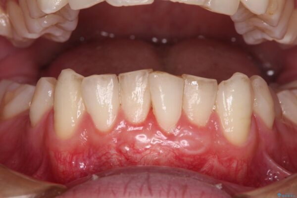 ほぼ歯根全てが露出　2度の歯肉移植術で自然な見た目に 治療後画像