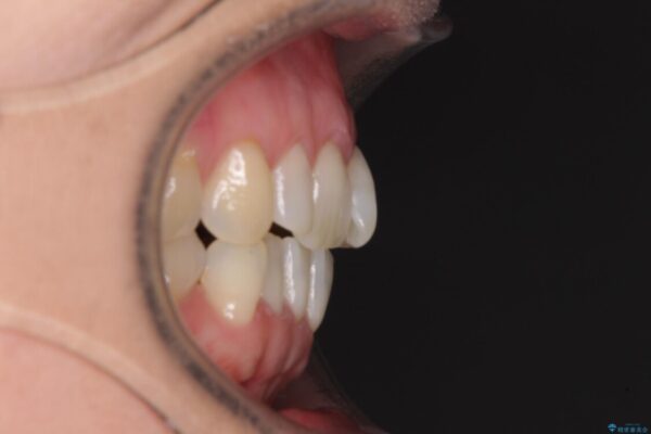 前歯のスペースが気になる　インビザラインによる矯正治療 治療前画像