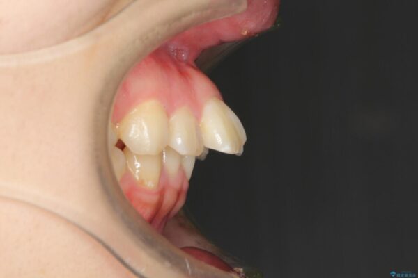 飛び出した前歯を引っ込めたい　目立たないワイヤーでの抜歯矯正 治療前画像