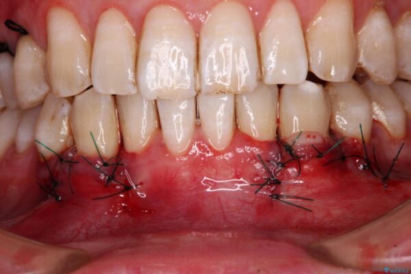 しみてしまう下顎の犬歯　歯肉移植による根面被覆 治療途中画像