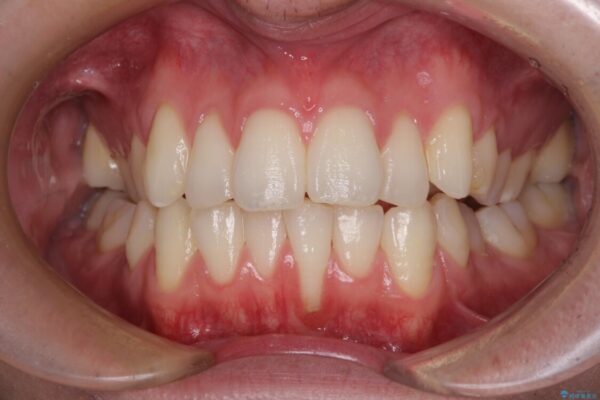 ほぼ歯根全てが露出　2度の歯肉移植術で自然な見た目に 治療前画像