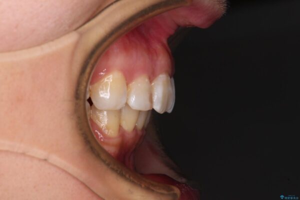 飛び出した前歯を引っ込めたい　目立たないワイヤーでの抜歯矯正 治療後画像