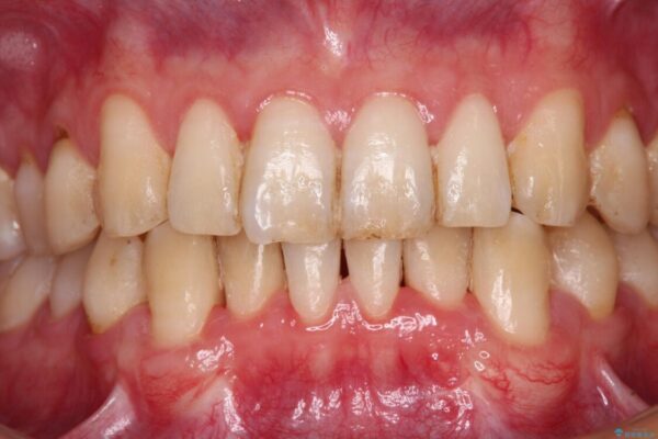 しみてしまう下顎の犬歯　歯肉移植による根面被覆 治療前画像